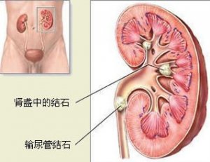 输尿管结石患者应该做哪些检查？