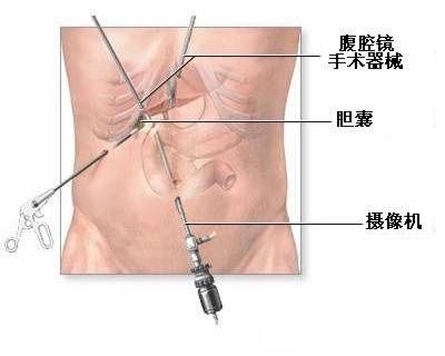 胆囊切除术常识