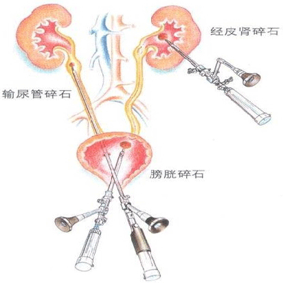 引起输尿管结石的原因